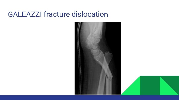 GALEAZZI fracture dislocation 