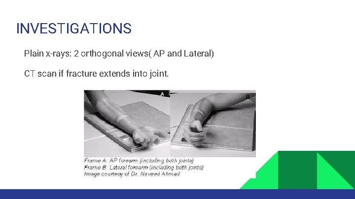 INVESTIGATIONS Plain x-rays: 2 orthogonal views( AP and Lateral) CT scan if fracture extends