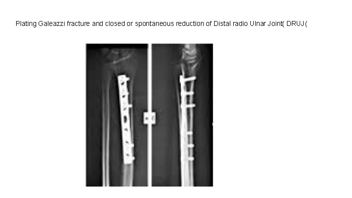 Plating Galeazzi fracture and closed or spontaneous reduction of Distal radio Ulnar Joint( DRUJ(
