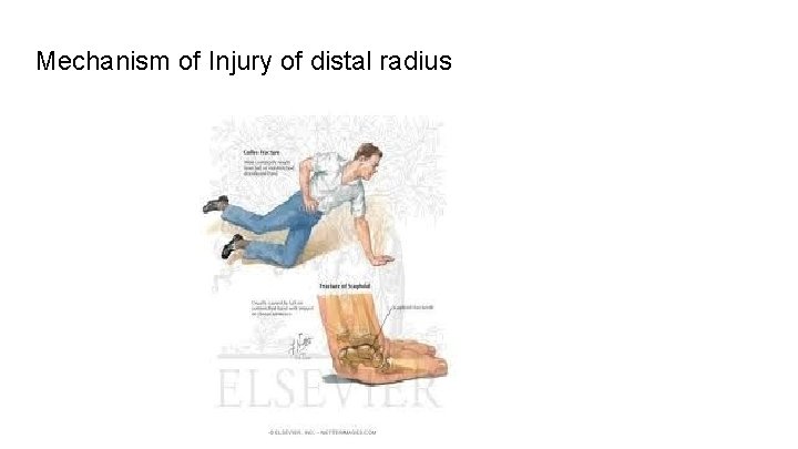 Mechanism of Injury of distal radius 