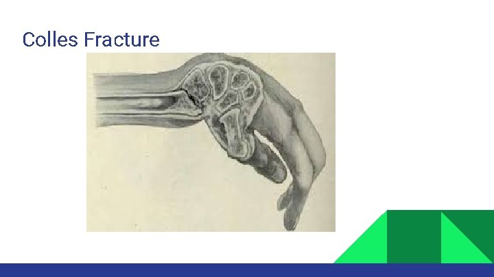 Colles Fracture 
