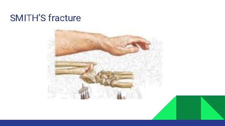 SMITH’S fracture 