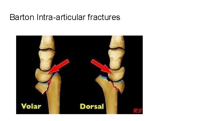 Barton Intra-articular fractures 