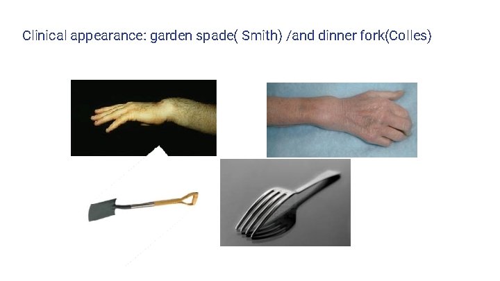 Clinical appearance: garden spade( Smith) /and dinner fork(Colles) 