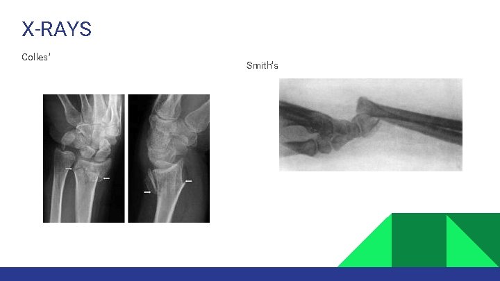 X-RAYS Colles’ Smith’s 