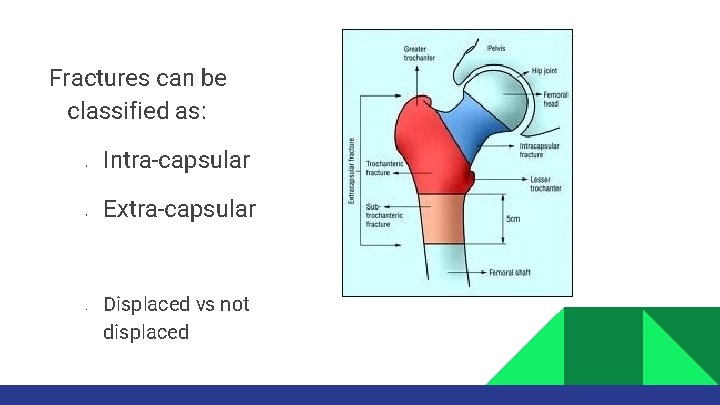 Fractures can be classified as: • • • Intra-capsular Extra-capsular Displaced vs not displaced