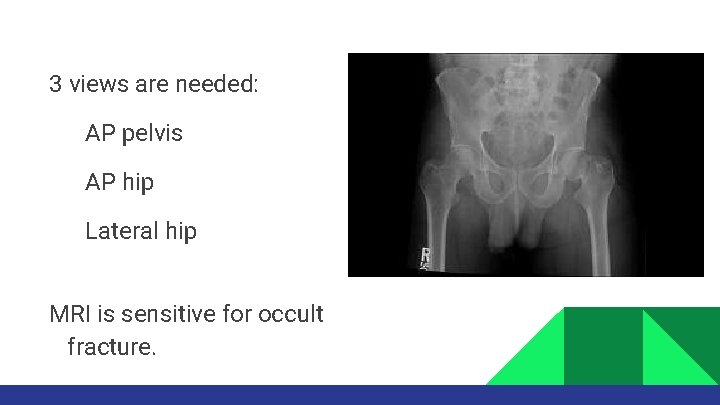 3 views are needed: AP pelvis AP hip Lateral hip MRI is sensitive for