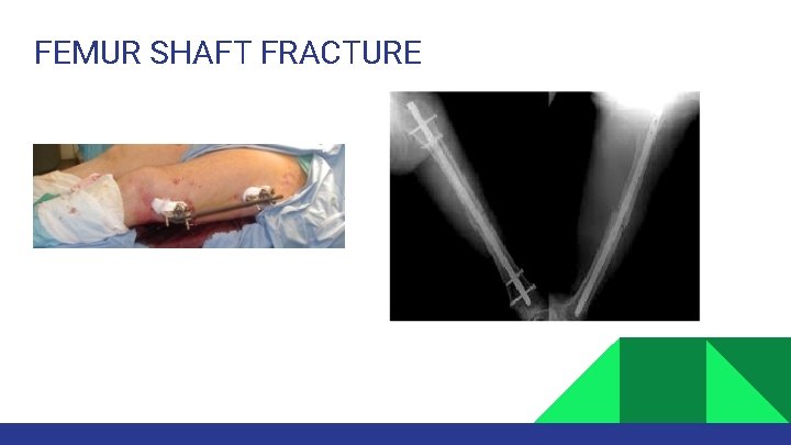 FEMUR SHAFT FRACTURE 