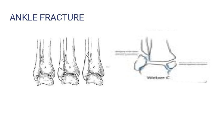 ANKLE FRACTURE 