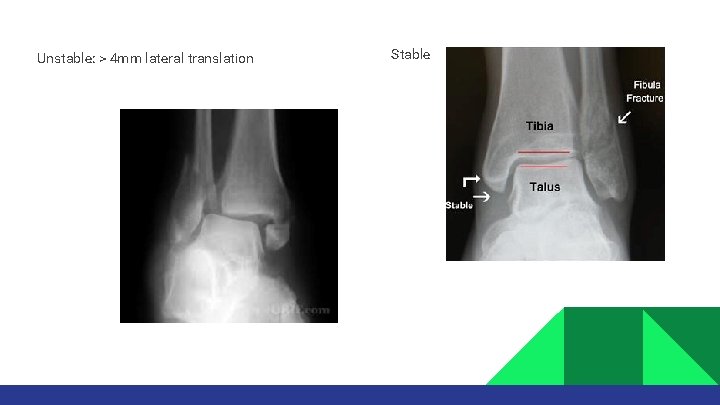 Unstable: > 4 mm lateral translation Stable 