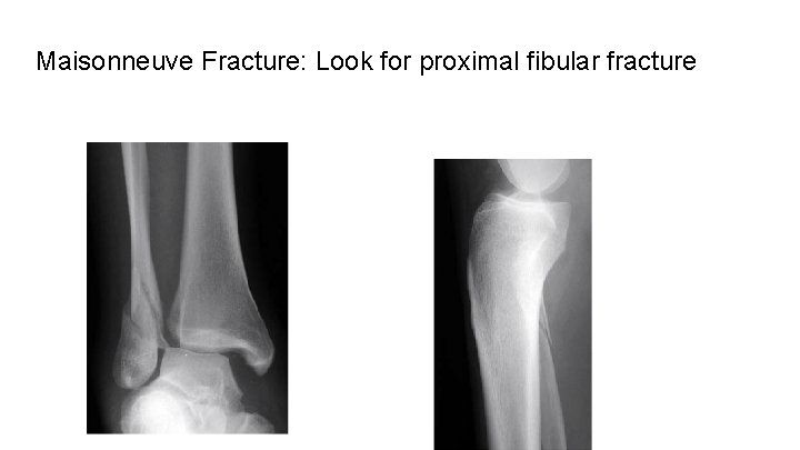 Maisonneuve Fracture: Look for proximal fibular fracture 