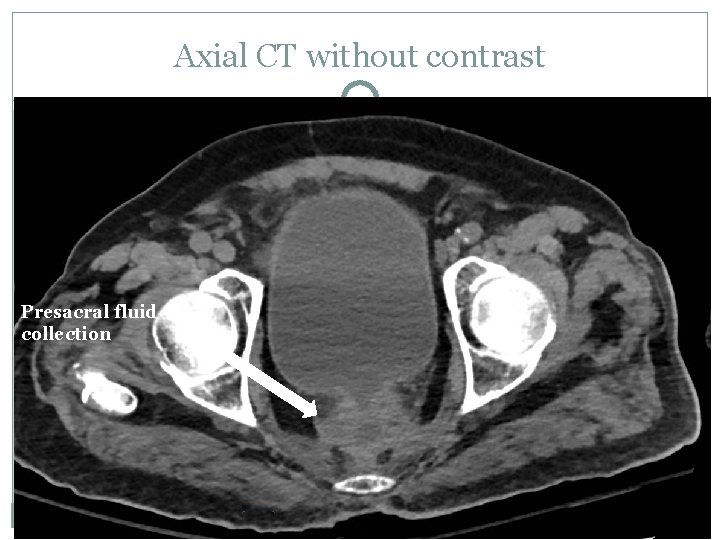Axial CT without contrast Presacral fluid collection 