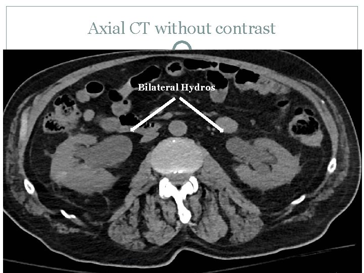 Axial CT without contrast Bilateral Hydros 