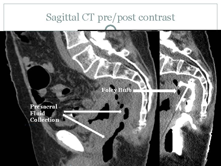 Sagittal CT pre/post contrast Foley Bulb Presacral Fluid Collection 