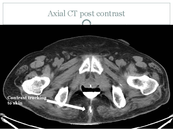 Axial CT post contrast Contrast tracking to skin 