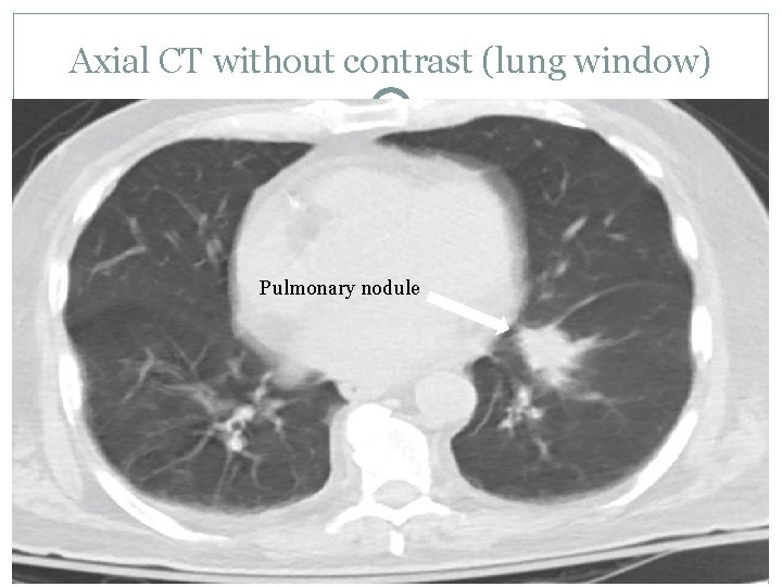 Axial CT without contrast (lung window) Pulmonary nodule 