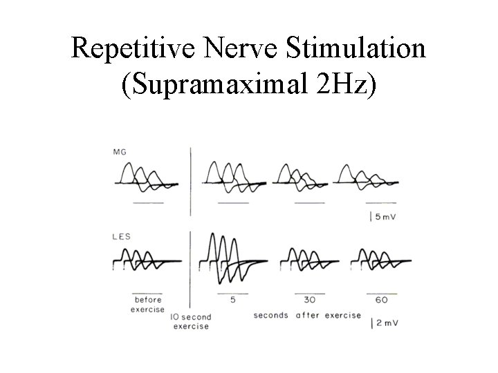 Repetitive Nerve Stimulation (Supramaximal 2 Hz) 