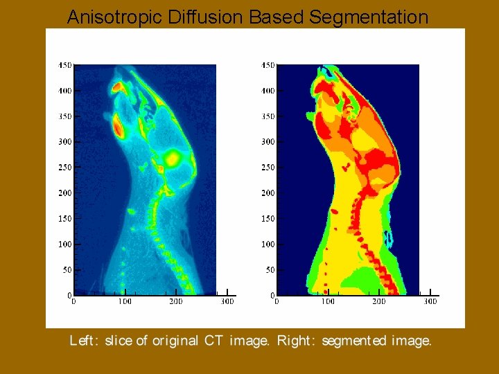 Anisotropic Diffusion Based Segmentation 