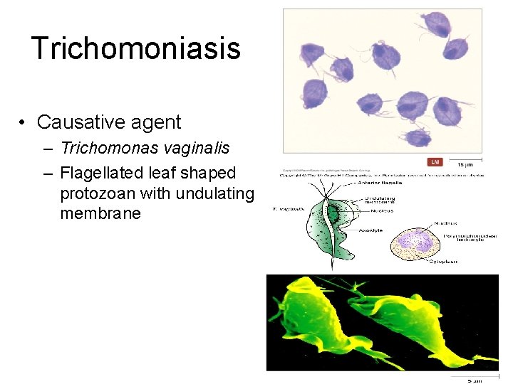 Trichomoniasis • Causative agent – Trichomonas vaginalis – Flagellated leaf shaped protozoan with undulating