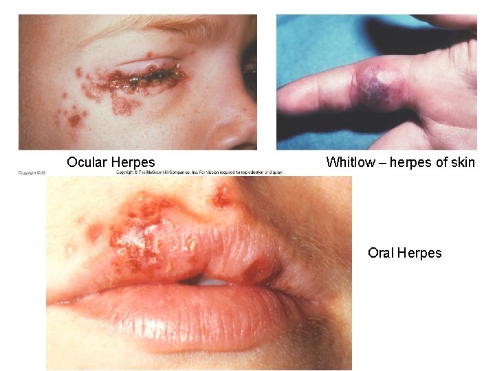 Ocular Herpes Whitlow – herpes of skin Oral Herpes 