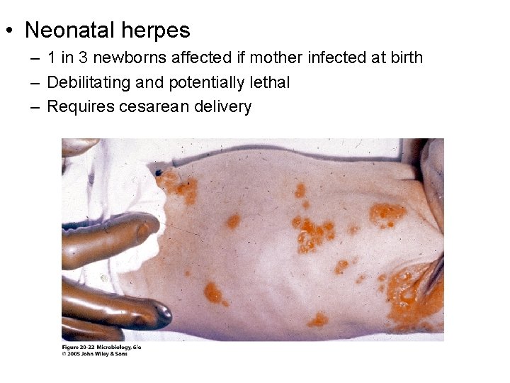  • Neonatal herpes – 1 in 3 newborns affected if mother infected at