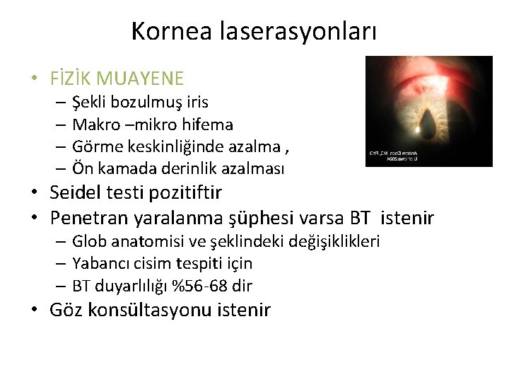 Kornea laserasyonları • FİZİK MUAYENE – Şekli bozulmuş iris – Makro –mikro hifema – Kornea laserasyonları • FİZİK MUAYENE – Şekli bozulmuş iris – Makro –mikro hifema –