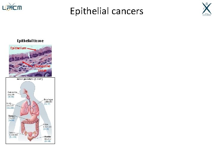 Epithelial cancers Epithelial tissue Epithelium Connective tissue 