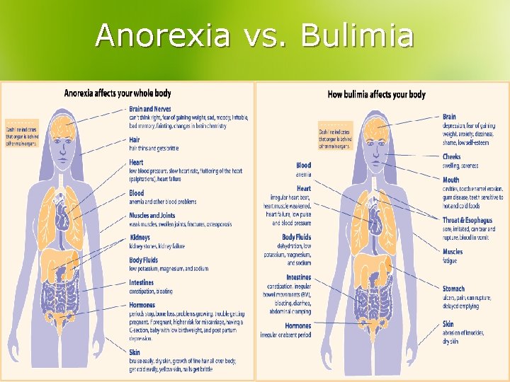 Anorexia vs. Bulimia 