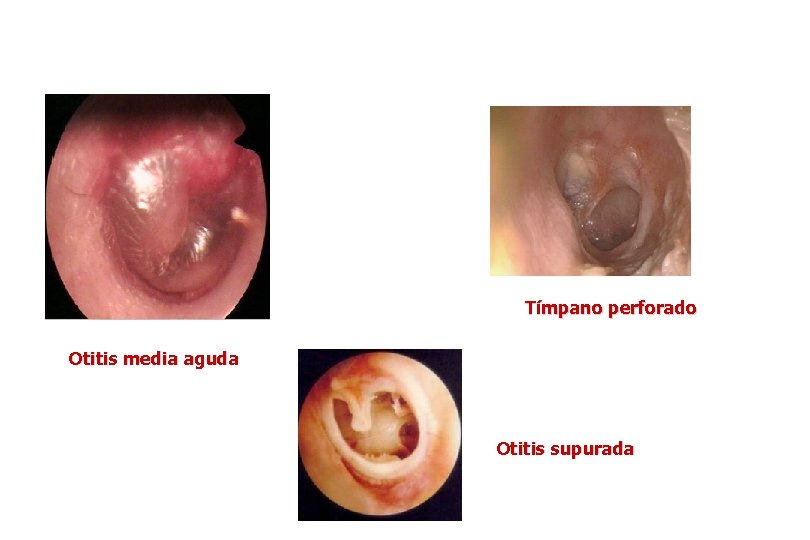 Tímpano perforado Otitis media aguda Otitis supurada 