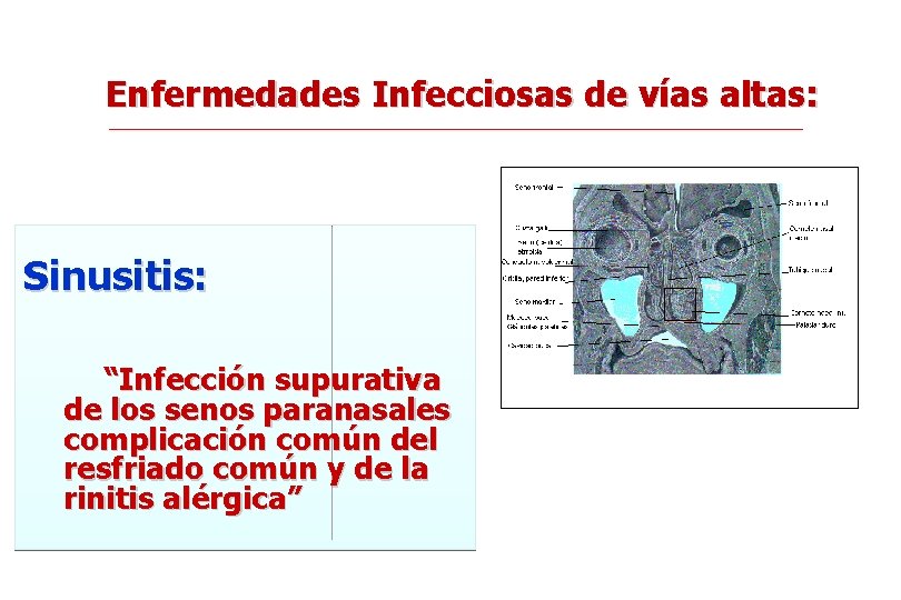 Enfermedades Infecciosas de vías altas: Sinusitis: “Infección supurativa de los senos paranasales complicación común