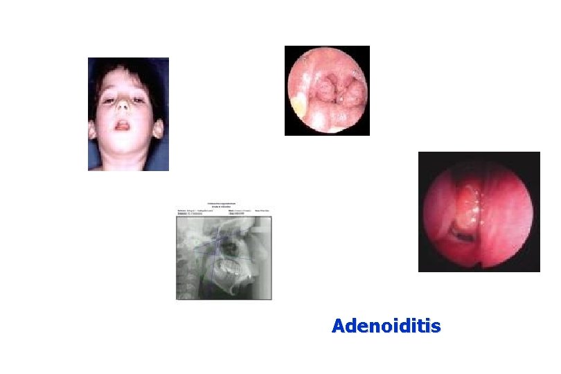 Adenoiditis 