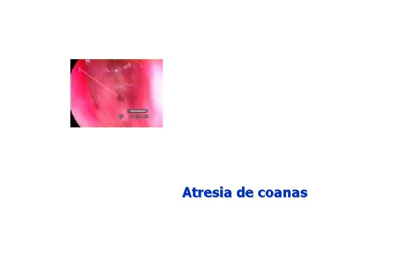 Atresia de coanas 