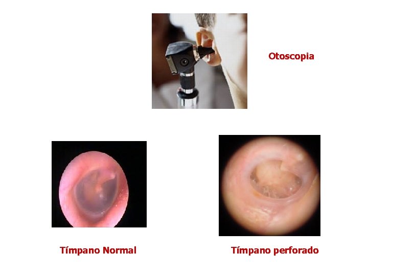 Otoscopia Tímpano Normal Tímpano perforado 