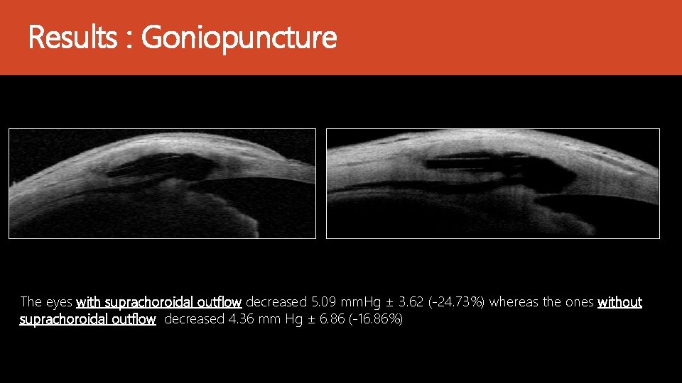 Results : Goniopuncture The eyes with suprachoroidal outflow decreased 5. 09 mm. Hg ±