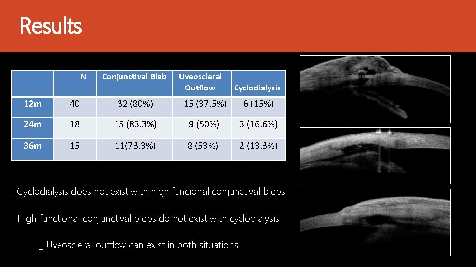 Results N Conjunctival Bleb Uveoscleral Outflow Cyclodialysis 12 m 40 32 (80%) 15 (37.