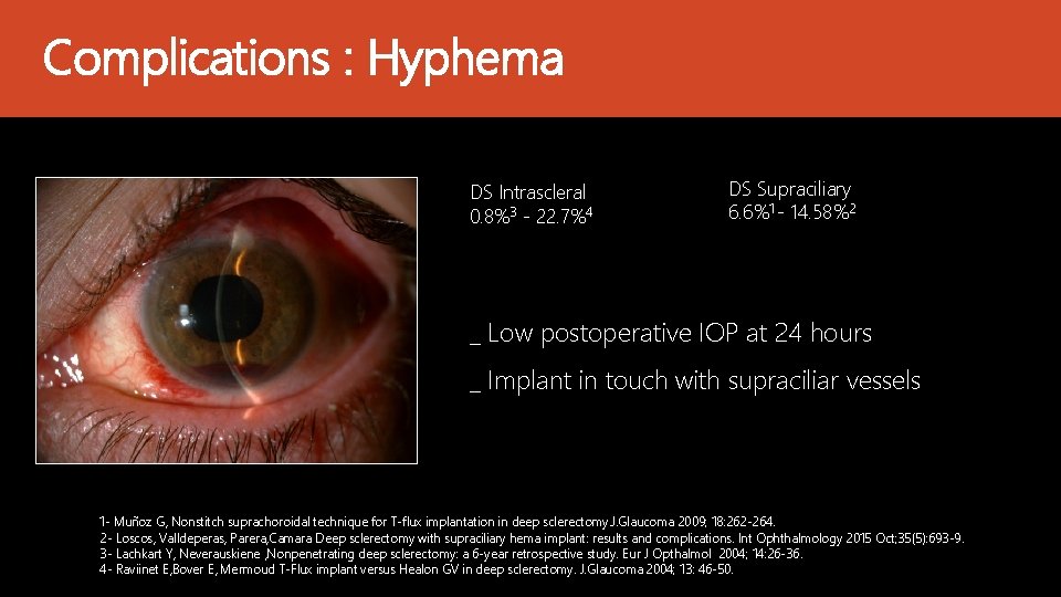 Complications : Hyphema DS Intrascleral 0. 8%3 - 22. 7%4 DS Supraciliary 6. 6%1