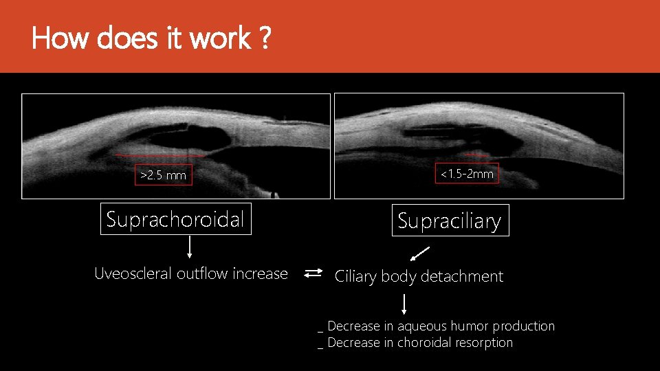 How does it work ? ˃2. 5 mm Suprachoroidal Uveoscleral outflow increase <1. 5