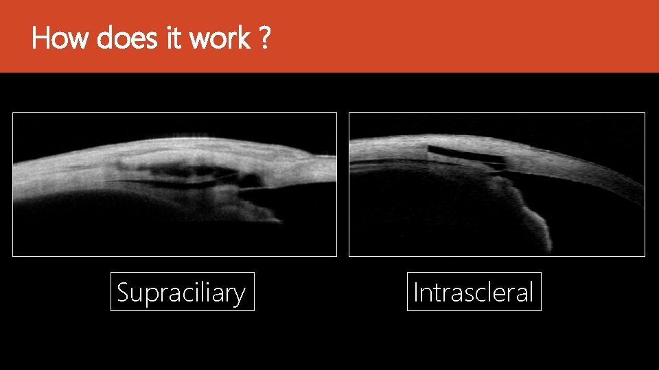 How does it work ? Supraciliary Intrascleral 