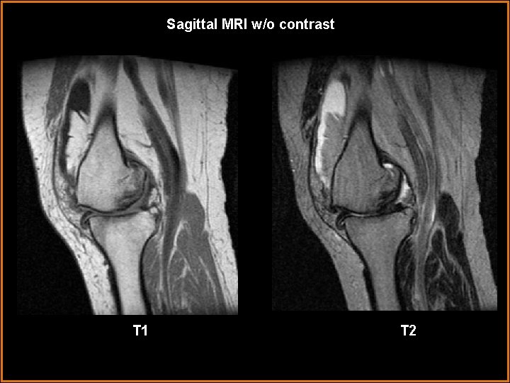 Sagittal MRI w/o contrast T 1 T 2 