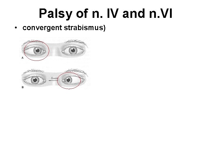 Palsy of n. IV and n. VI • convergent strabismus) 