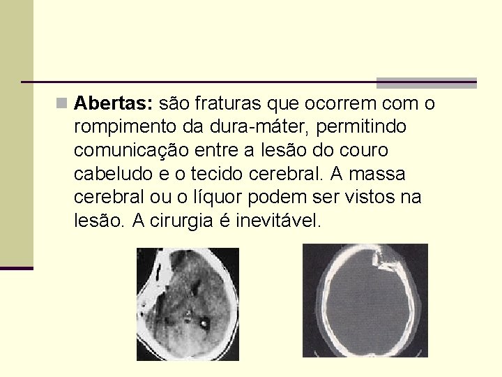 n Abertas: são fraturas que ocorrem com o rompimento da dura-máter, permitindo comunicação entre
