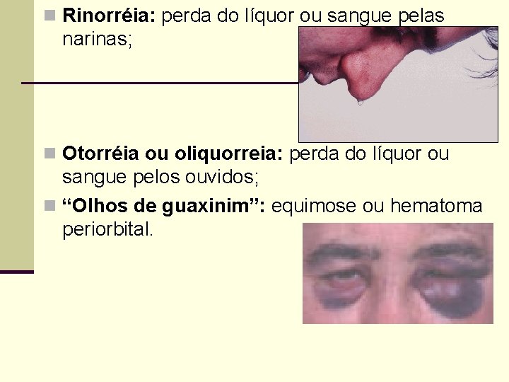 n Rinorréia: perda do líquor ou sangue pelas narinas; n Otorréia ou oliquorreia: perda