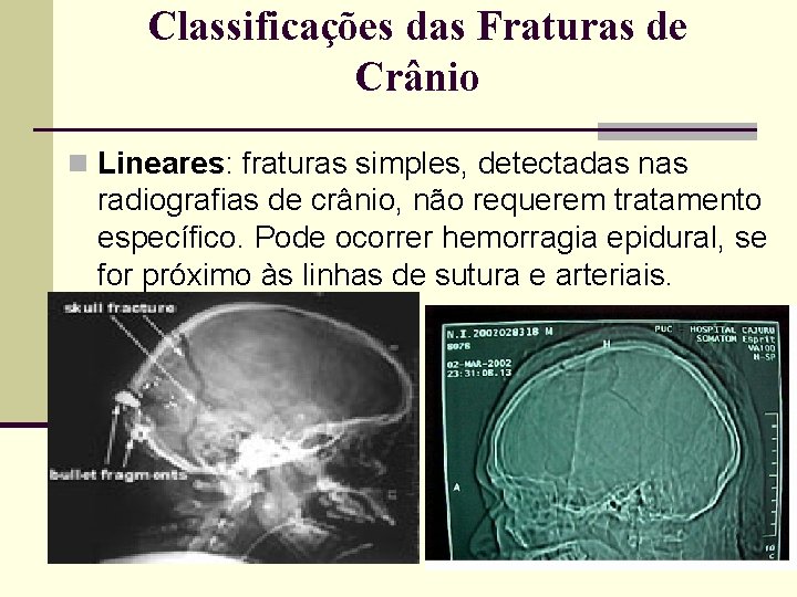 Classificações das Fraturas de Crânio n Lineares: fraturas simples, detectadas nas radiografias de crânio,