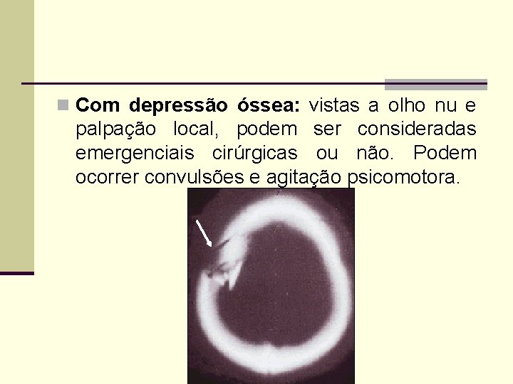 n Com depressão óssea: vistas a olho nu e palpação local, podem ser consideradas