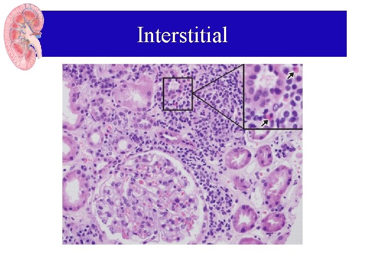 Interstitial Interstitial
