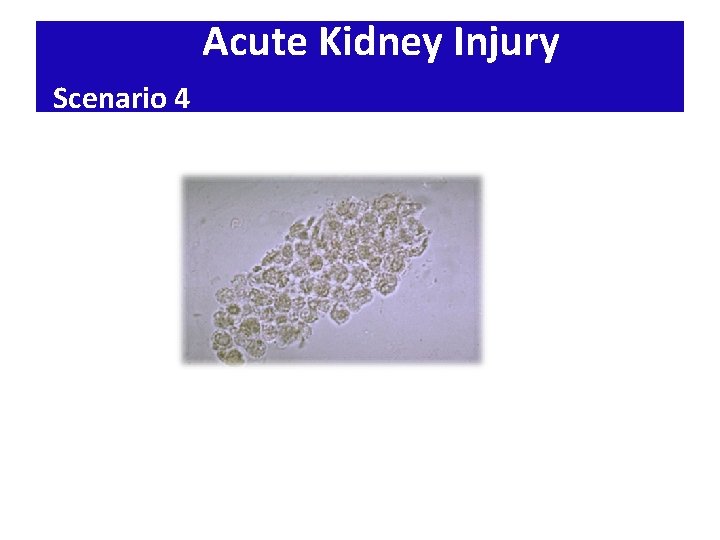 Acute Kidney Injury Scenario 4 Acute Kidney Injury Scenario 4