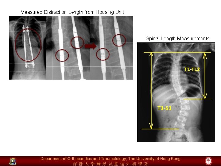 Measured Distraction Length from Housing Unit Spinal Length Measurements T 1 -T 12 T