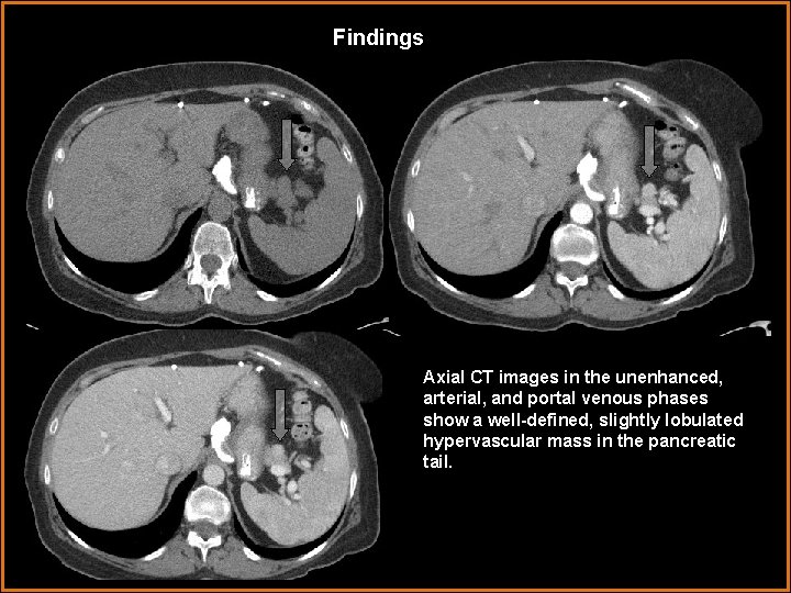 Findings Axial CT images in the unenhanced, arterial, and portal venous phases show a