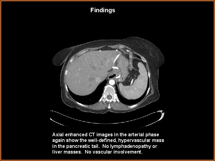 Findings Axial enhanced CT images in the arterial phase again show the well-defined, hypervascular