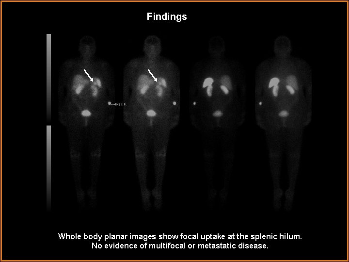Findings Whole body planar images show focal uptake at the splenic hilum. No evidence